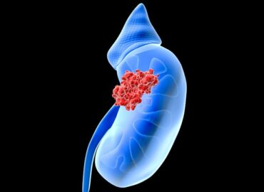 Urothelial cancer (coming soon)