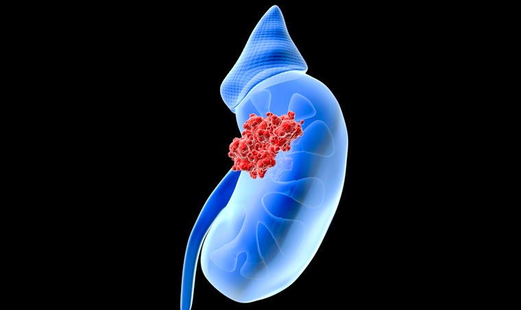 Official Release: Saudi National Guidelines for Urothelial Cancer